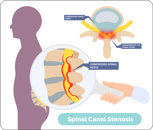 Spinal Canal Stenosis Treatment Symptoms Causes Anssi