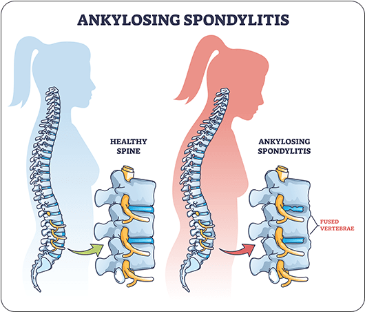 Ankylosing Spondylitis Symptoms Causes And Treatment Anssi