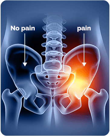 Pelvic Girdle Pain (PGP)
