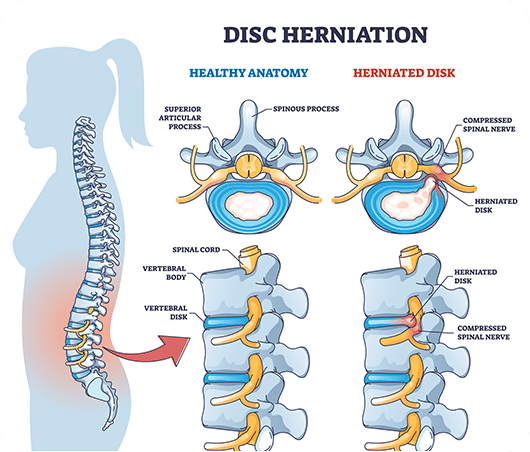 slipped-disc-treatment-symptoms-causes-anssi