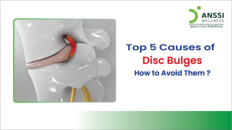 Disc bulges are a common spinal issue that can lead to chronic back pain and limited mobility.