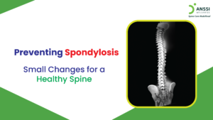 Spondylosis is a common age-related condition that results from the wear and tear of the spine over time.